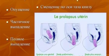 Смещение матки влево причины и последствия