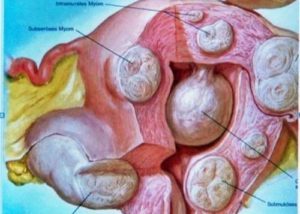 Узловая фибромиома матки