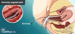 Биопсия эндометрия что показывает