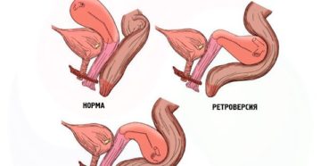Что означает матка отклонена кзади
