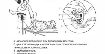 Массаж матки при опущении