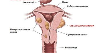 Миома на ножке чем опасна