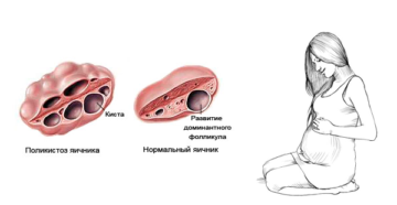 Как забеременеть при поликистозе яичников