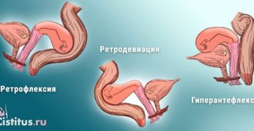 Что такое ретродевиация матки