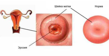 По какой причине шейка матки может быть красная