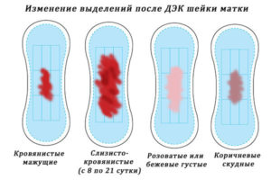 Выделения после прижигания