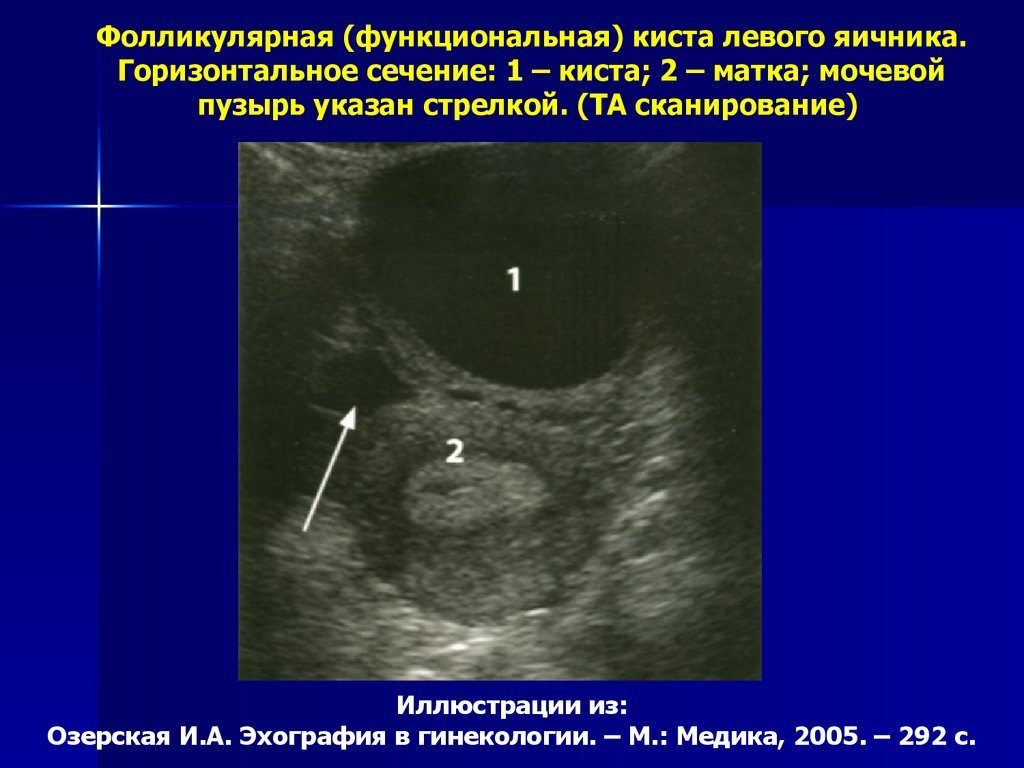 Функциональная киста правого и левого яичника