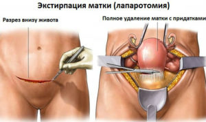 В каком случае удаляют матку