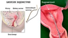 Что такое биопсия эндометрия