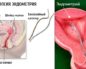 Что такое биопсия эндометрия
