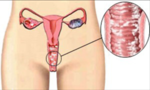 Как лечить вагинальный кандидоз у женщин