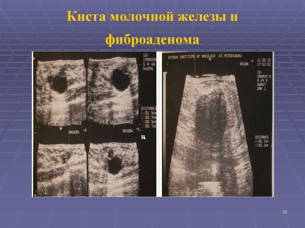 Чем киста отличается от фиброаденомы молочной железы