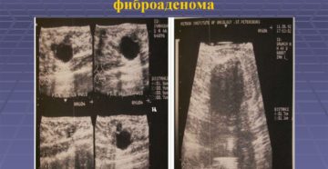 Чем киста отличается от фиброаденомы молочной железы