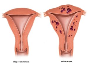 Является ли аденомиоз матки раком