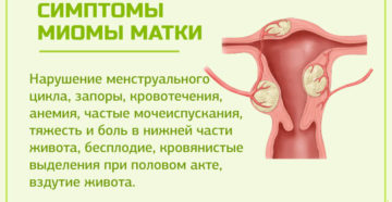 Симптомная миома матки