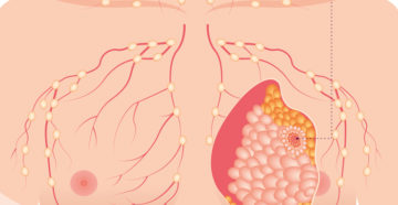 Как быстро растет раковая опухоль молочной железы
