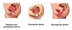 Опущение матки в гинекологии