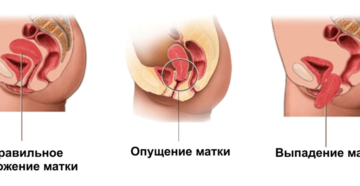 Опущение матки в гинекологии