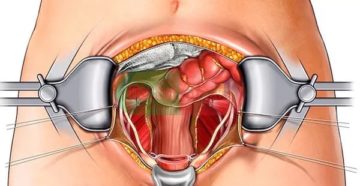 Что происходит с организмом после удаления матки