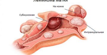 Субмукозная лейомиома матки