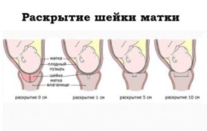 Длинная шейка матки перед родами что делать