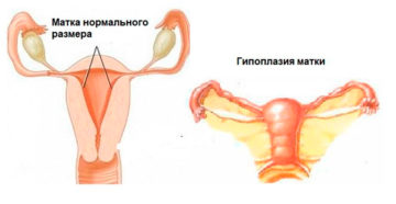 Что такое гипоплазия матки