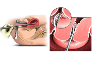 Выскабливание матки