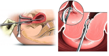 Выскабливание матки
