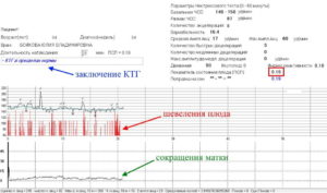 КТГ плода при беременности: показатели, результаты