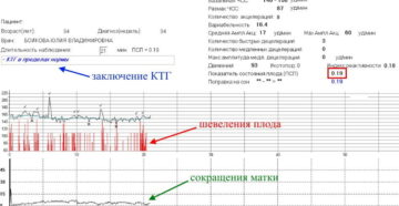 КТГ плода при беременности: показатели, результаты