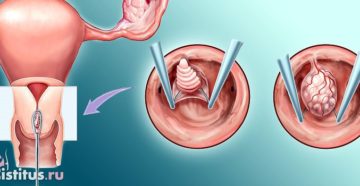 Удаление полипа в цервикальном канале