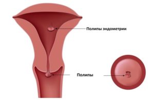 Удаление полипа эндометрия лазером