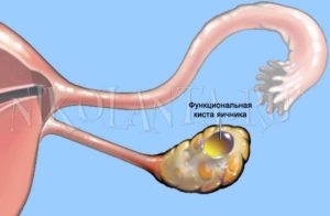 Чем лечить кисту яичника медикаментозно