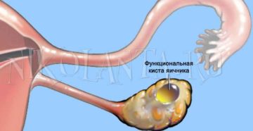 Чем лечить кисту яичника медикаментозно