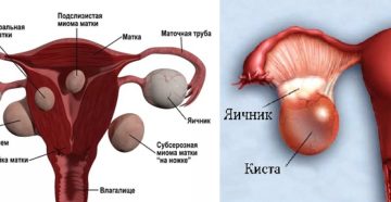 Киста и миома в чем разница