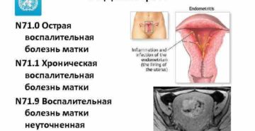 Хроническая воспалительная болезнь матки