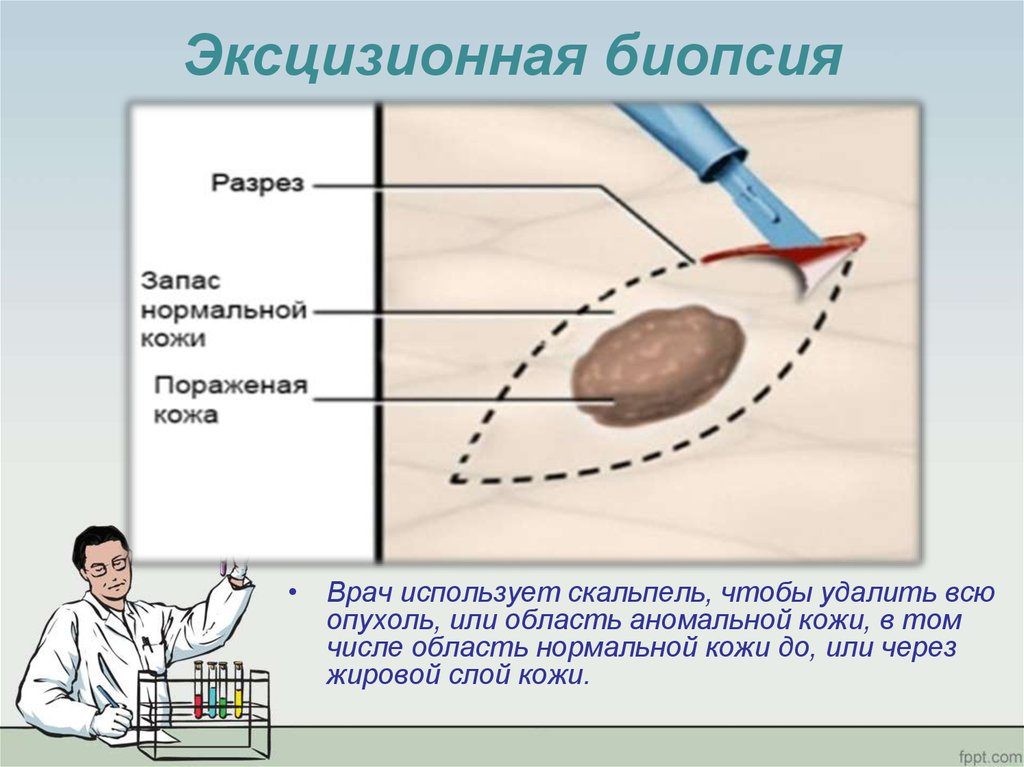 Эксцизионная биопсия что это