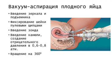 Вакуум аспирация эндометрия что это такое