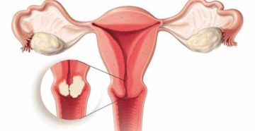Поликистоз шейки матки