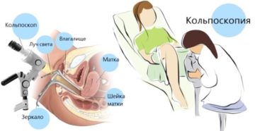 Что показывает кольпоскопия шейки матки
