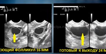 Как быстро растут фолликулы