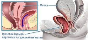 Опущение мочевого пузыря у женщин симптомы