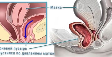 Опущение мочевого пузыря у женщин симптомы