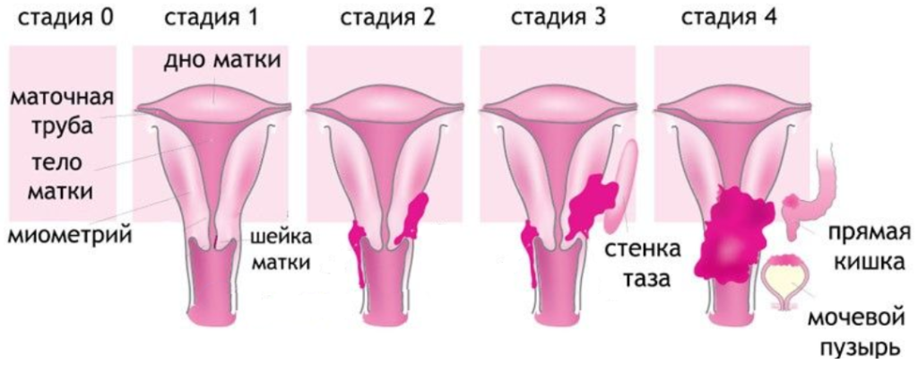 Первая стадия рака шейки матки