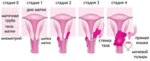 Первая стадия рака шейки матки