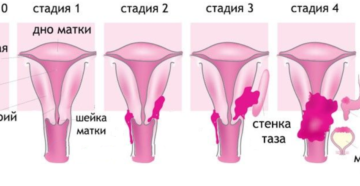 Первая стадия рака шейки матки