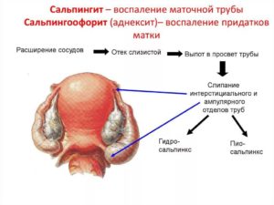 Сальпингоофорит: классификация, симптомы и лечение