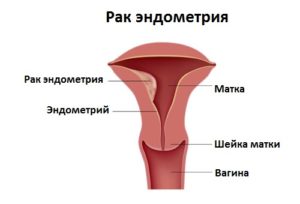 Симптомы и признаки рака эндометрия матки