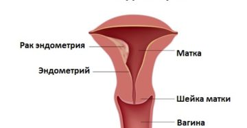 Симптомы и признаки рака эндометрия матки