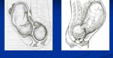 Низкое расположение матки